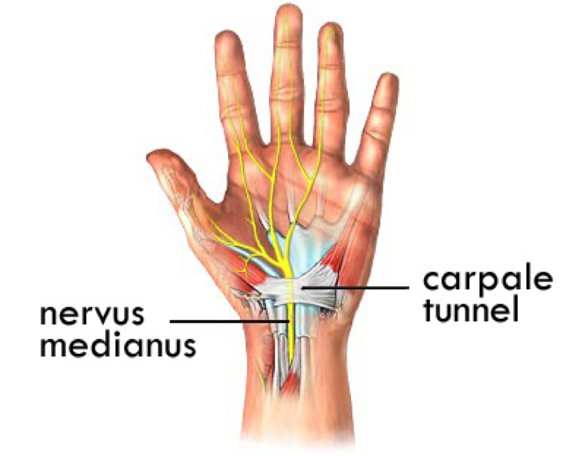 Carpaal tunnel syndroom hand