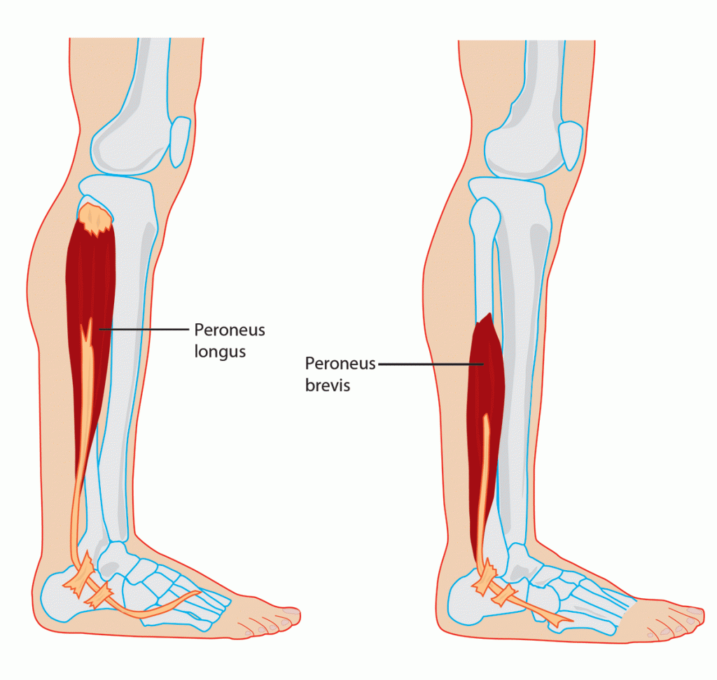 Peroneus tendinopathie