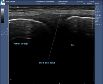 Echografie Knie Artrose