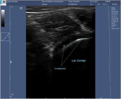 Knie artrose scan