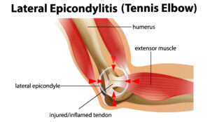 Epicondylitis_lateralis