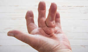 dupuytren behandeling