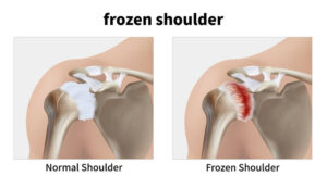 Frozen shoulder oefening
