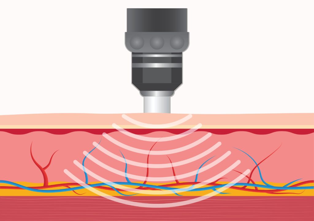  wat gebeurt er in je lichaam tijdens shockwave therapie